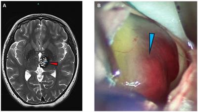 Lectin-type oxidized LDL receptor-1 as a potential therapeutic target for cerebral cavernous malformations treatment